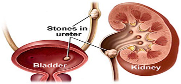Kidney stone specialist in noida